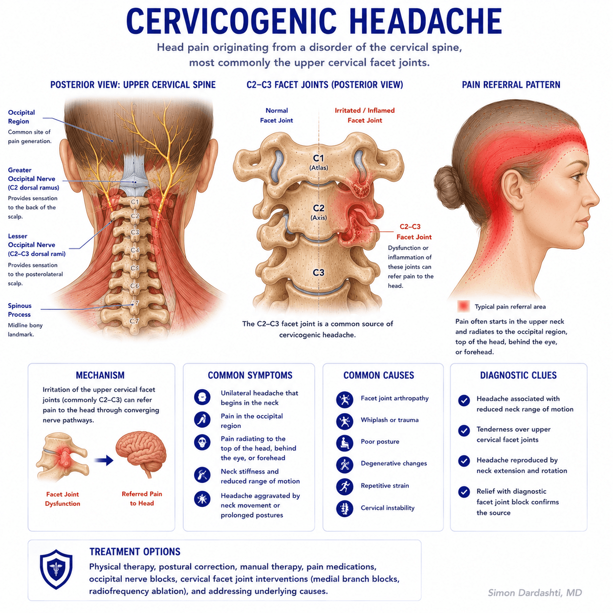 Cervicogenic headache showing upper cervical spine anatomy, cervical facet joints, cervical nerve roots C2-C3, and occipital nerves with referred pain pattern to head