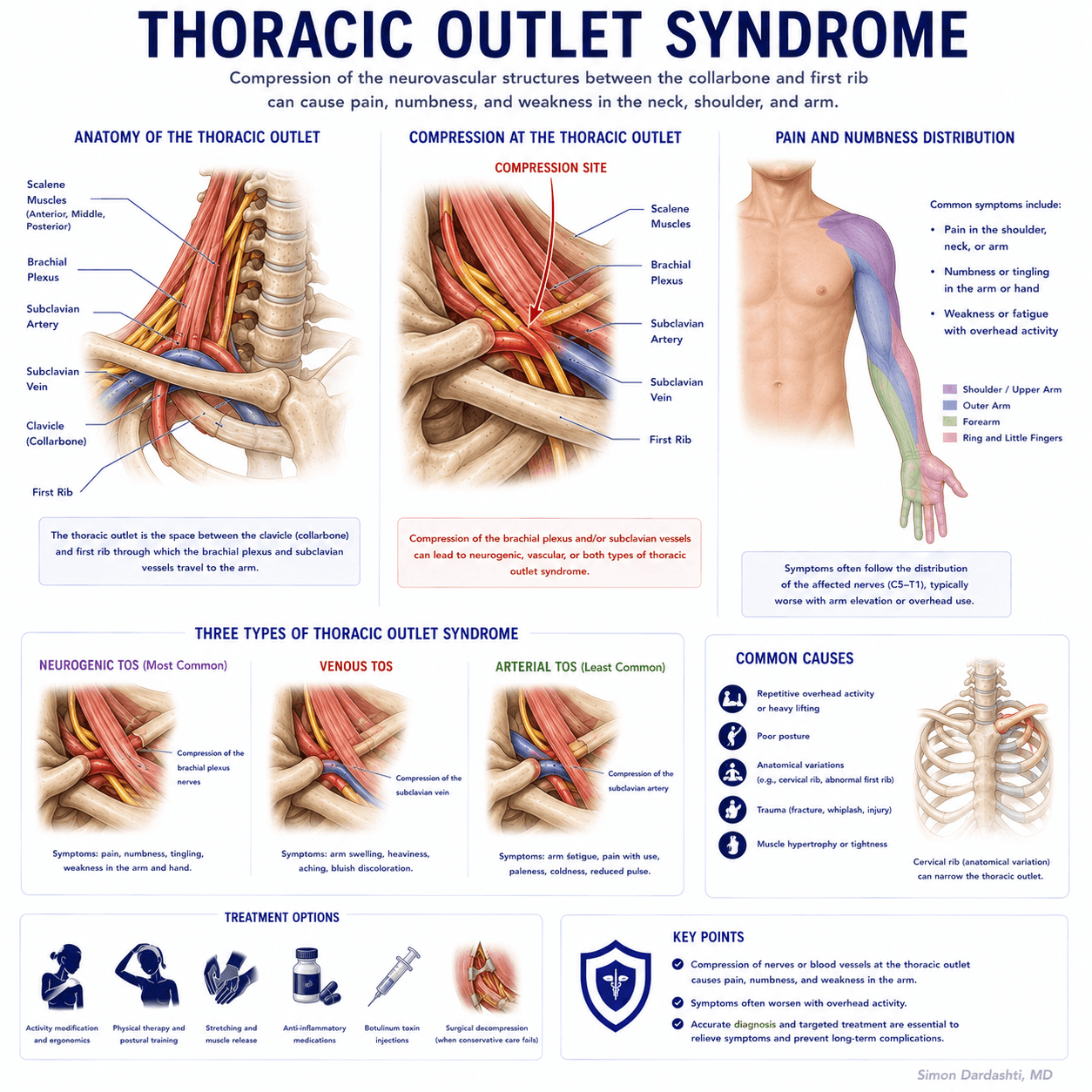 Thoracic outlet syndrome showing compression of the brachial plexus and blood vessels as they pass through the thoracic outlet between the collarbone, first rib, and shoulder muscles, illustrating anatomical narrowing and nerve/vessel compression