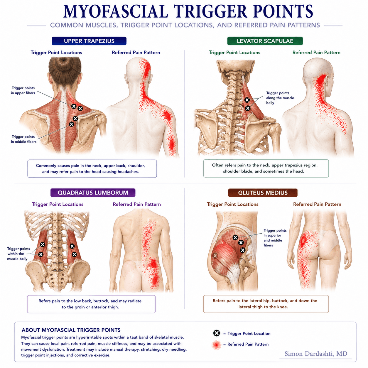 Myofascial trigger points showing localized tender points within muscle tissue and referred pain patterns radiating to distant areas