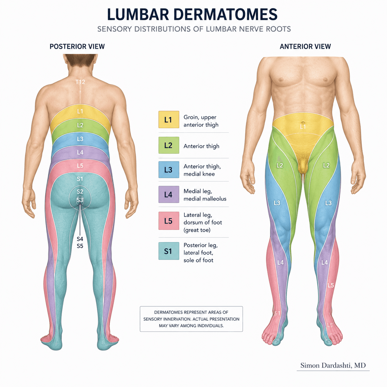 Lumbar dermatomes showing nerve root distribution from L1 through S1, illustrating the typical sensory distribution pattern of radicular pain radiating from the lower back into the leg and foot