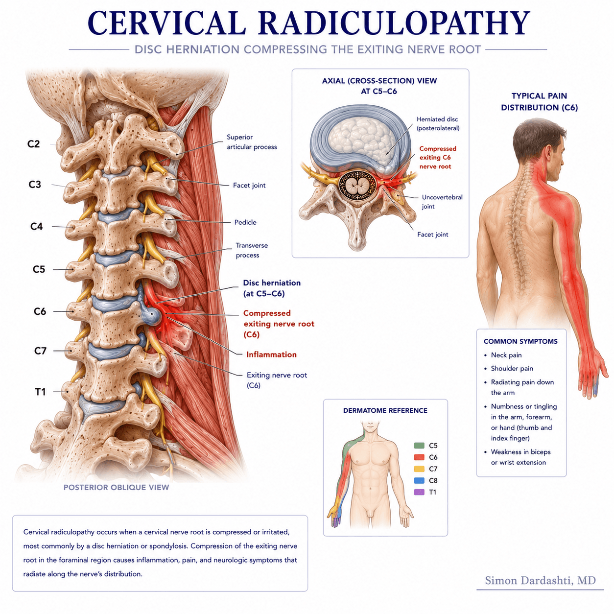 Cervical radiculopathy showing nerve root compressed by herniated disc or bone spurs at cervical vertebra level, with resulting pain radiation down arm
