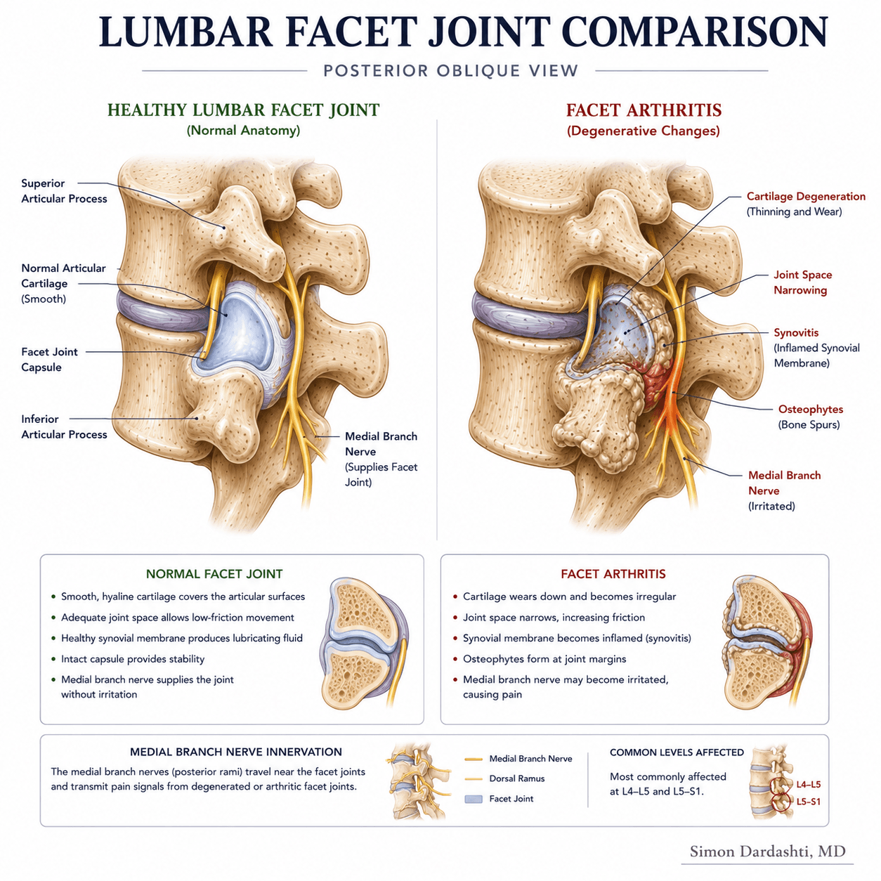 Facet arthritis showing degenerative changes at lumbar facet joint including cartilage loss, bone spur formation, and joint space narrowing with inflammatory changes