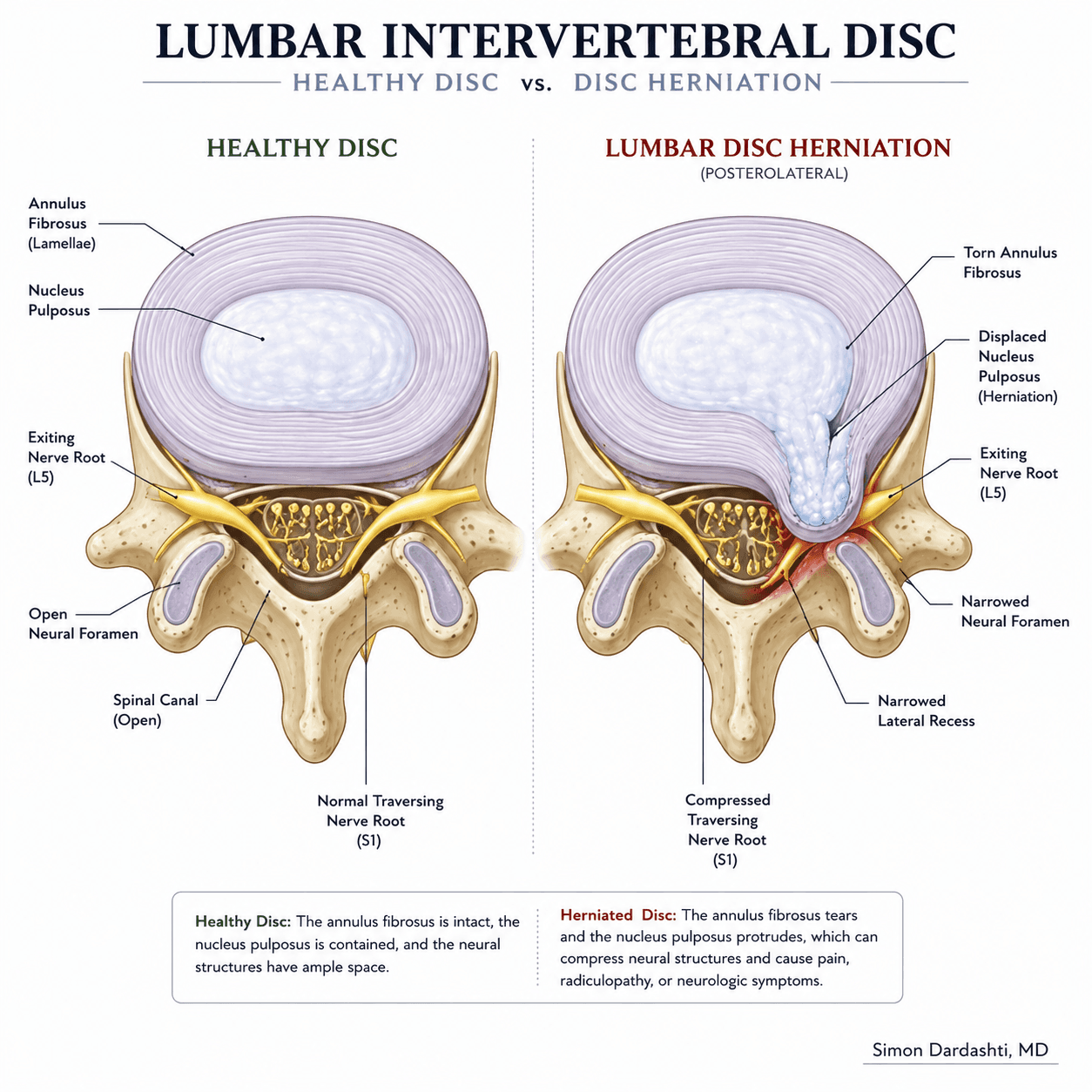 Side-by-side comparison showing healthy lumbar intervertebral disc on the left with normal nucleus pulposus and spinal nerve root, and herniated disc on the right with displaced nucleus pulposus compressing the nerve root