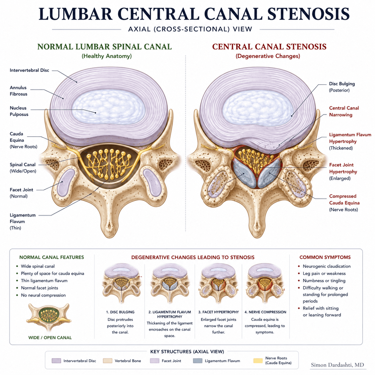 Cross-sectional view of lumbar spine showing central canal stenosis with narrowing of the lumbar spinal canal from multiple sources including bone spurs, ligament thickening, and disc bulging