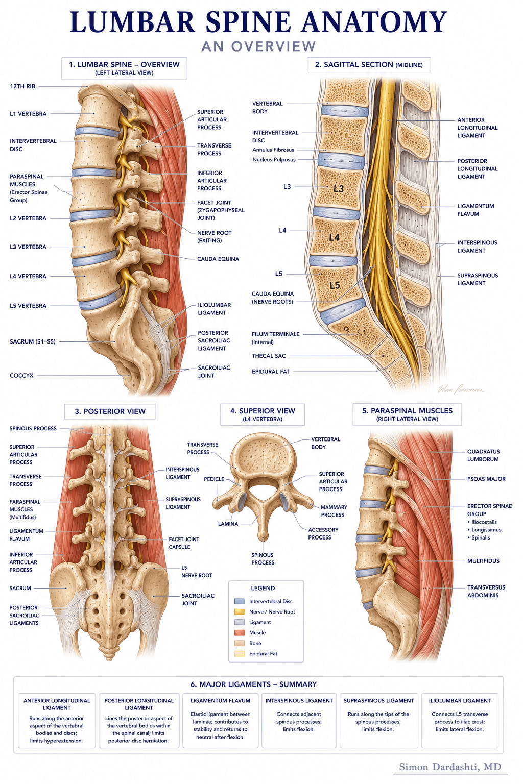 Lumbar radiculopathy showing nerve root compressed by herniated disc at lumbar vertebra level, with pain radiation down leg and foot