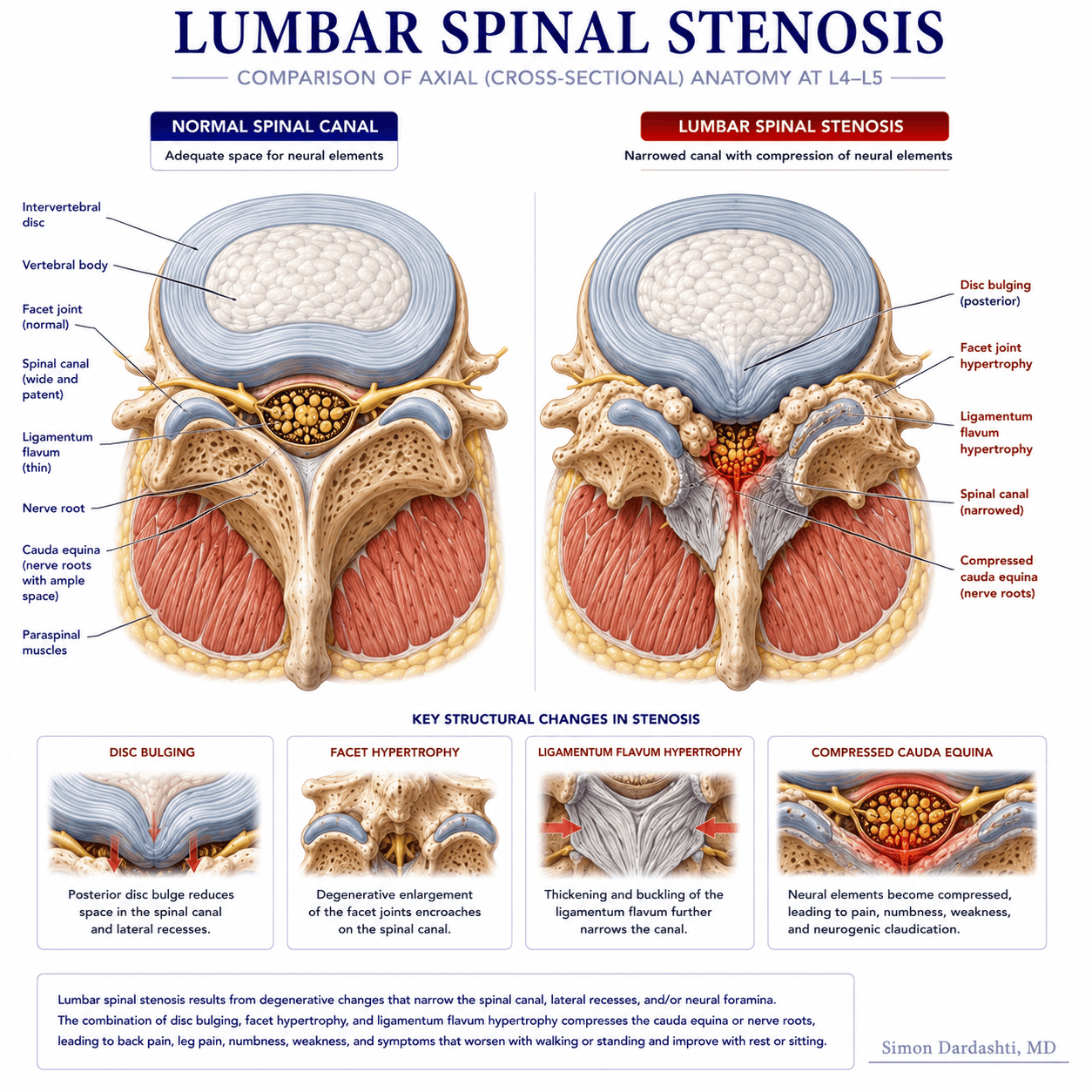 Lumbar spinal stenosis showing narrowing of the lumbar spinal canal with ligament thickening, bone spurs from degenerative disc disease, and facet arthritis compressing nerve structures