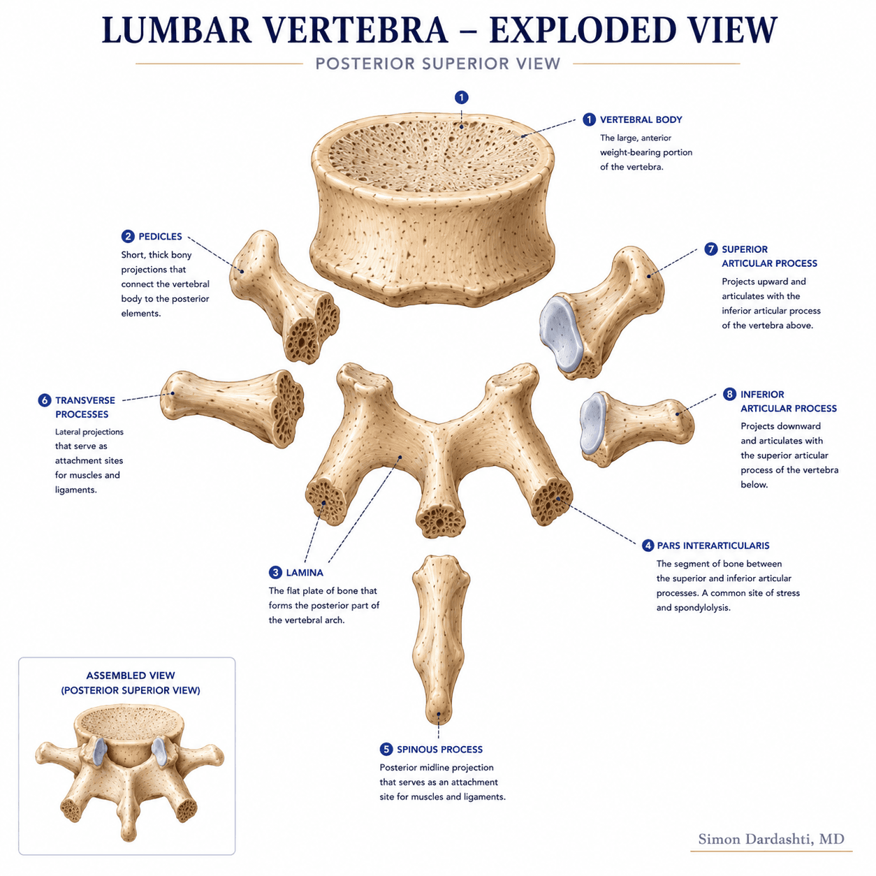 Exploded view of lumbar vertebra showing vertebral body, pedicles, laminae, spinous process, transverse processes, and facet joints