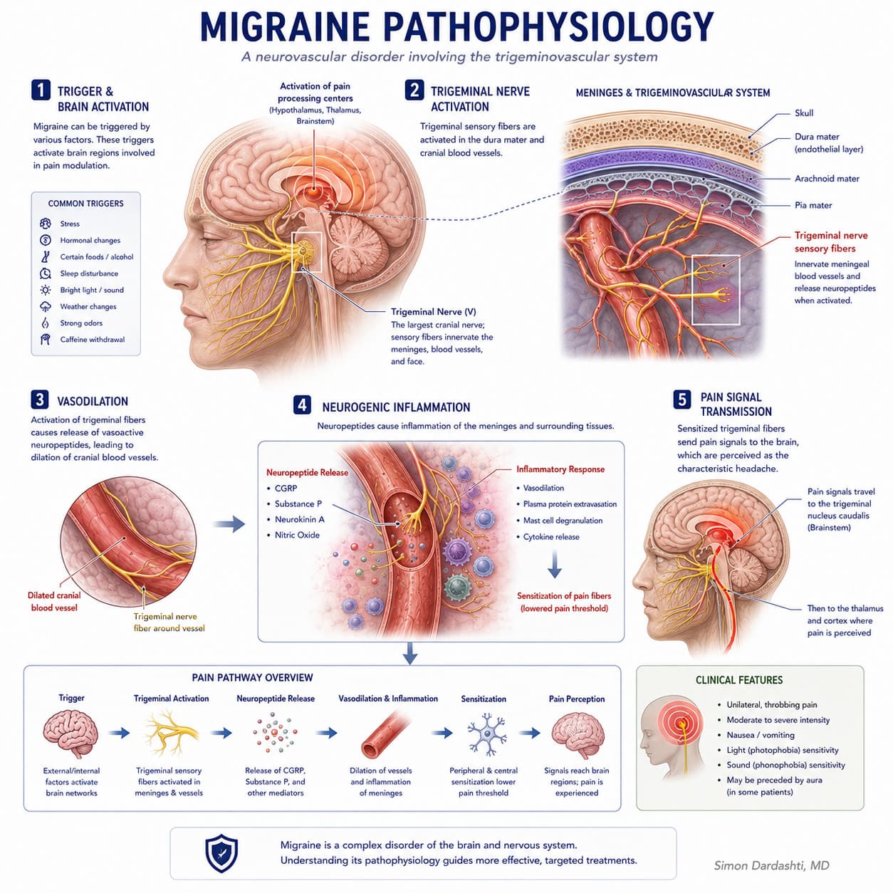 Migraine pathophysiology showing trigeminal nerve activation, neuropeptide release, neurogenic inflammation, sensitization, and transmission of pain signals to the brain.