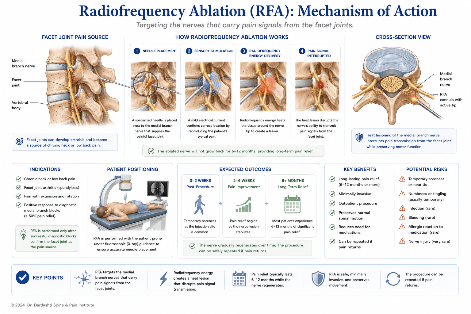 Radiofrequency ablation mechanism showing RF needle placement near medial branch nerve, electrical current delivery, heat generation (80-90°C), and thermal lesion of nerve tissue preventing pain signal transmission
