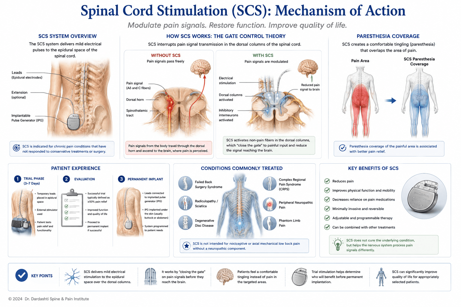 Spinal cord stimulation mechanism showing epidural lead placement at spinal cord, electrical pulse generation from implanted pulse generator, gate control theory application preventing pain signal transmission, and typical electrode array positioning