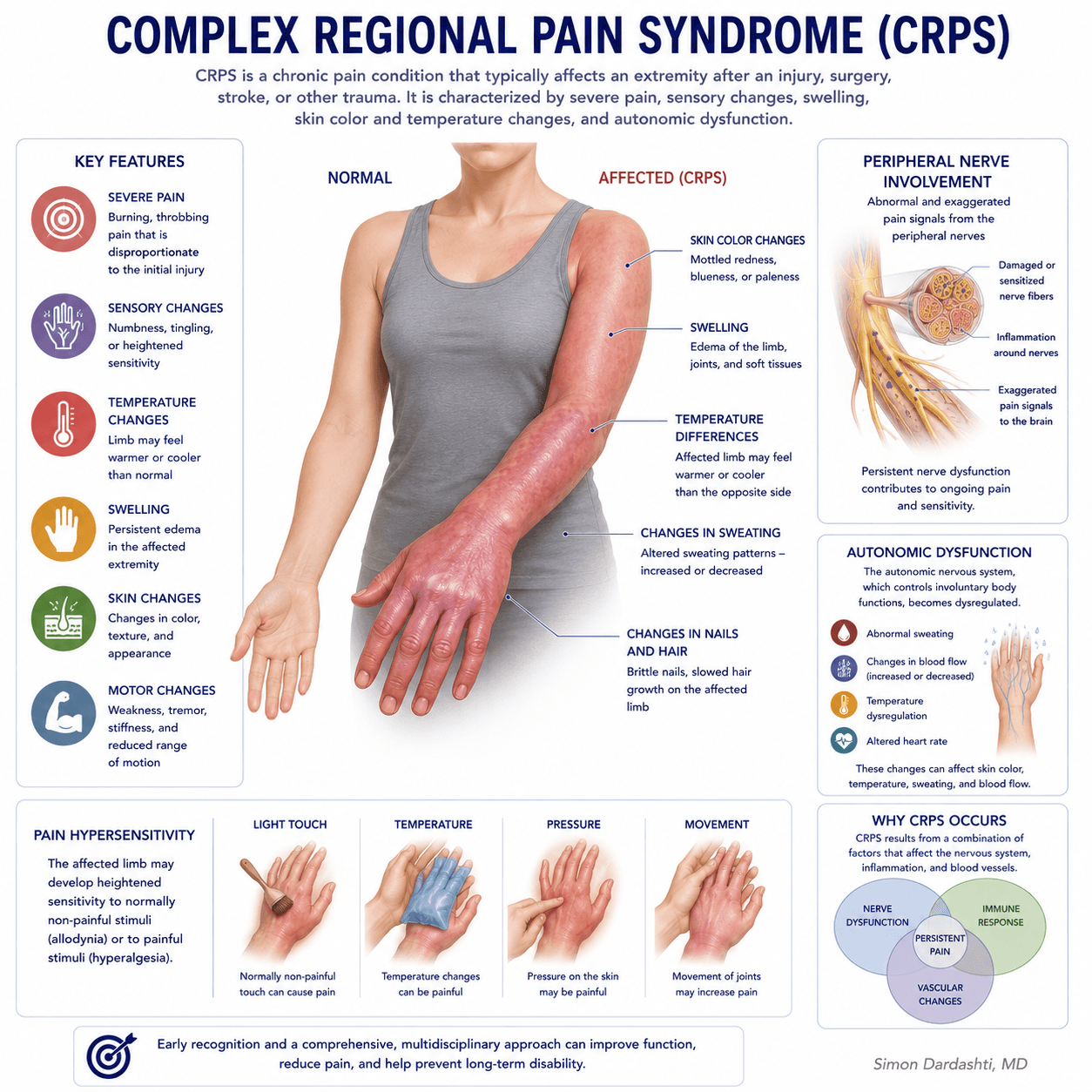 Complex regional pain syndrome showing peripheral sensitization, central sensitization, autonomic dysregulation, and neuroinflammatory changes contributing to chronic pain and associated symptoms