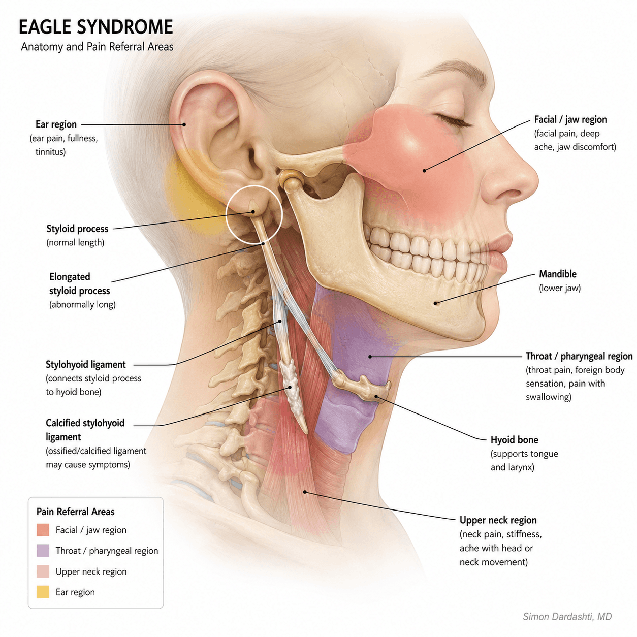 Medical illustration of Eagle syndrome showing the styloid process, stylohyoid ligament, throat, ear, jaw, and upper neck pain referral areas.