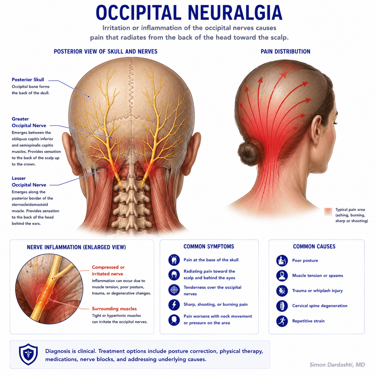 Occipital neuralgia showing greater and lesser occipital nerve anatomy, pain distribution at back of scalp and neck, and nerve irritation at cervical spine origin