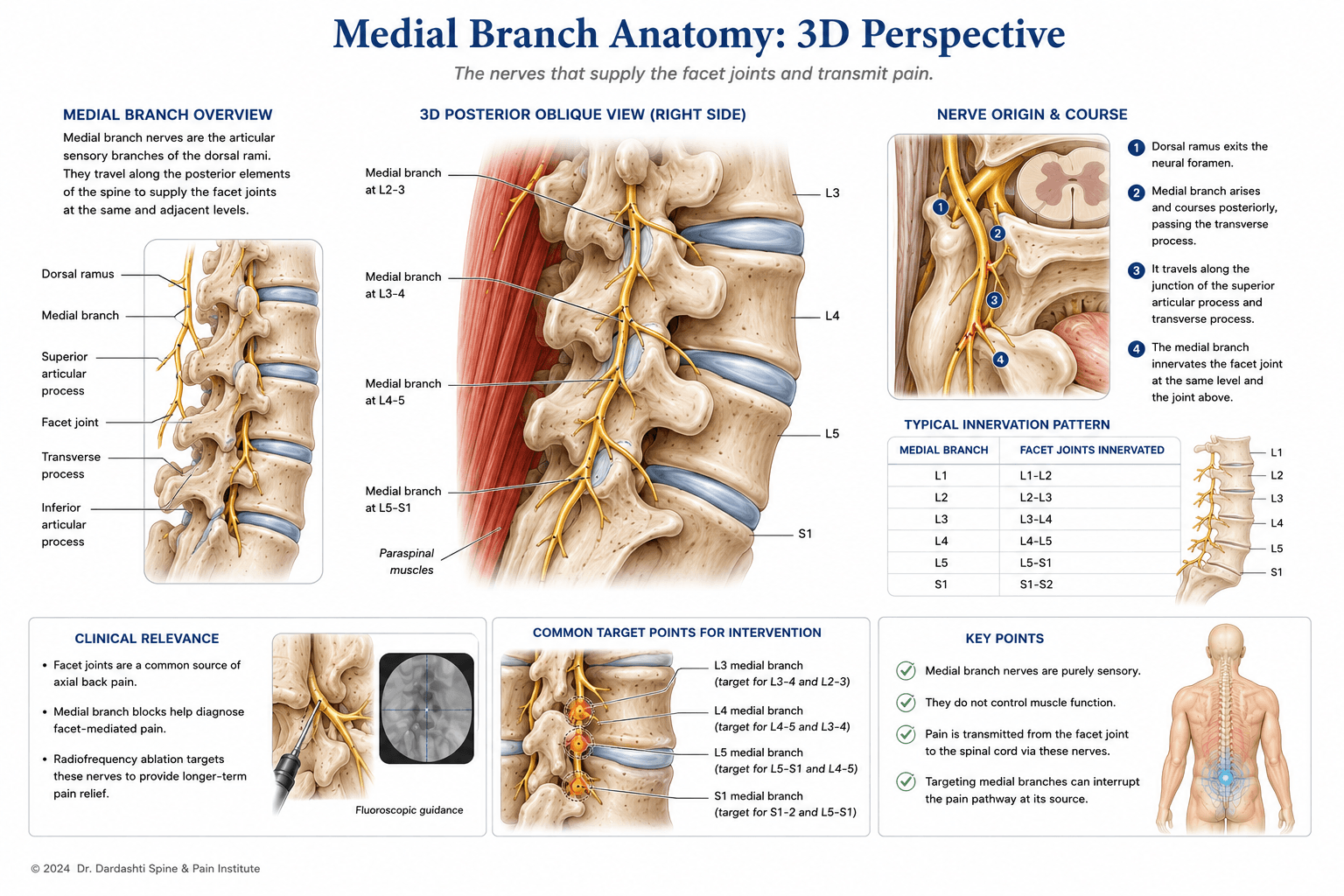 Three-dimensional anatomical perspective of medial branch nerves in lumbar spine showing bilateral nerve pathways, relationship to facet joints at multiple levels (L3, L4, L5), and needle targeting approach