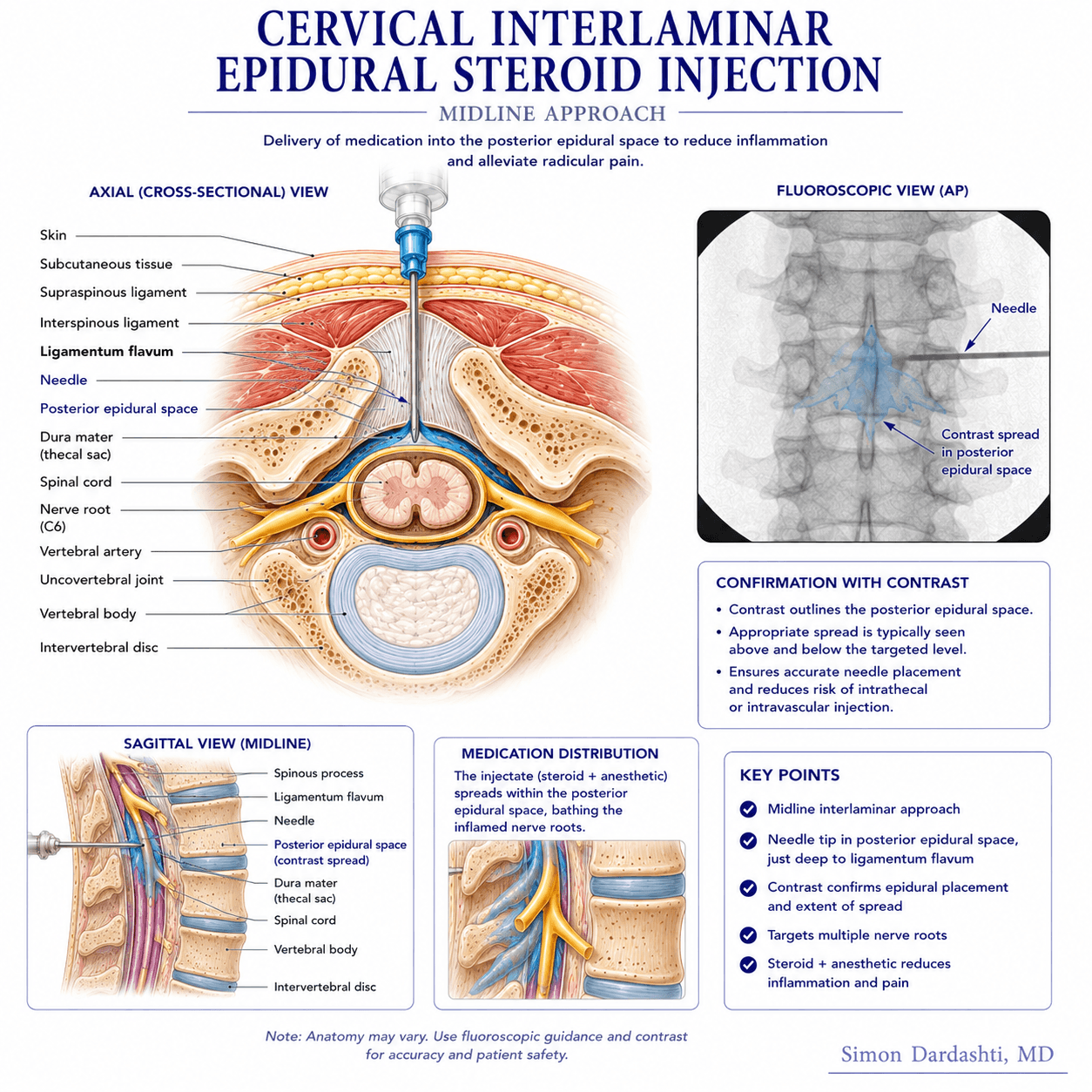 Cervical epidural steroid injection showing neck anatomy, needle trajectory at cervical vertebra level, epidural space anatomy at cervical spine, and medication placement