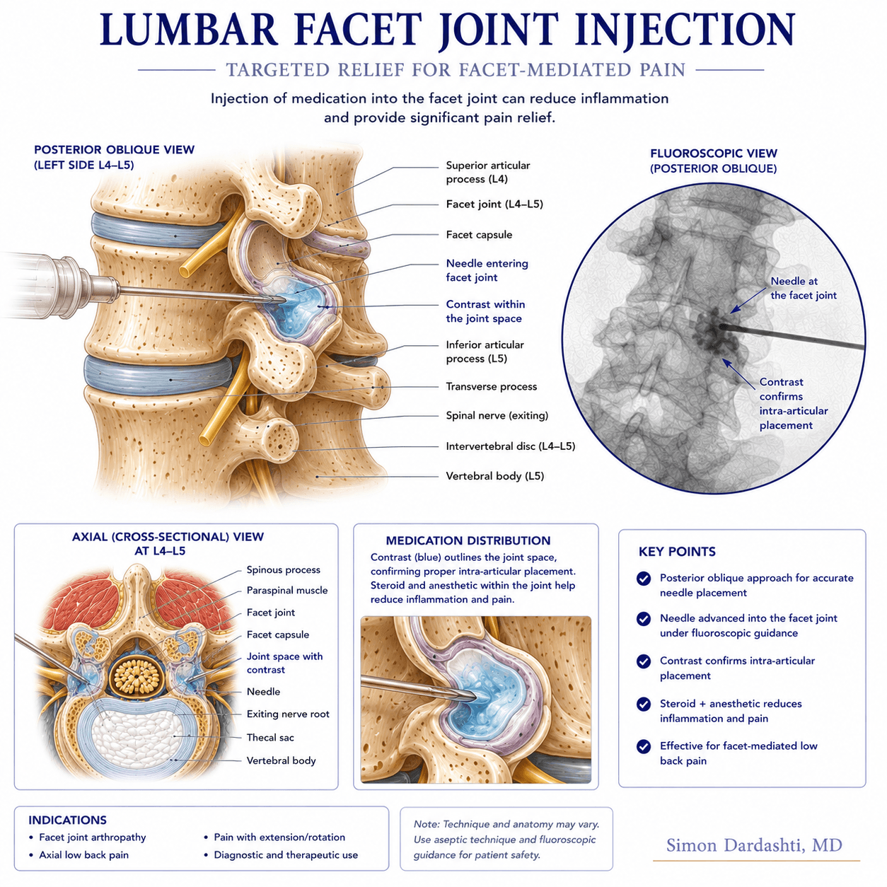 Facet joint injection showing needle advancement into facet joint space at lumbar vertebra level, intra-articular steroid placement, and joint anatomy with surrounding ligaments
