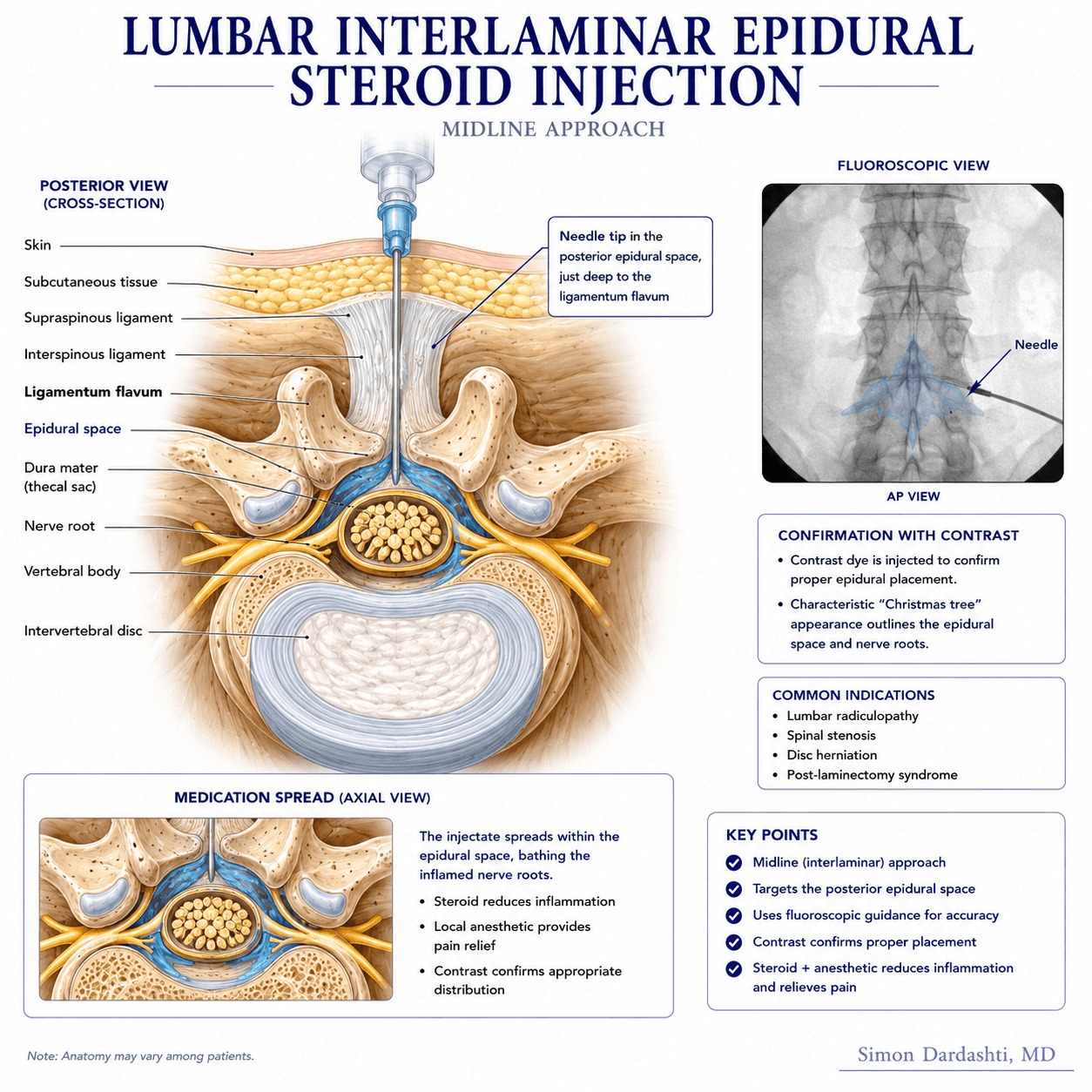 Lumbar epidural steroid injection technique showing vertebral anatomy, needle trajectory through tissues, epidural space identification, and steroid placement around lumbar nerve roots