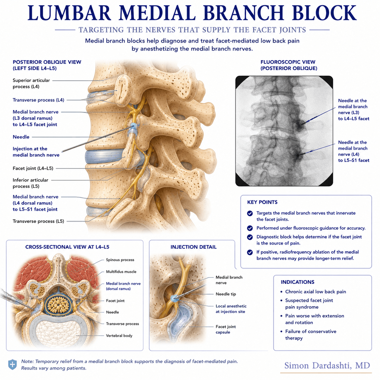 Medial branch block needle placement at the medial branch nerves showing fluoroscopic guidance and needle positioning targeting the nerve that supplies painful facet joints