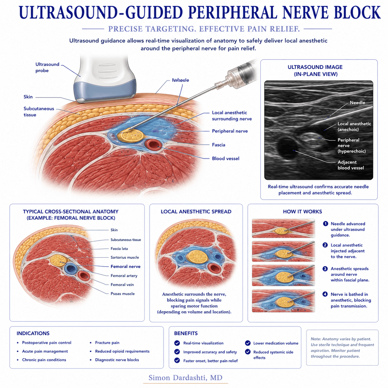 Peripheral nerve block technique showing needle placement along nerve pathway, local anesthetic delivery around nerve, and pain signal blockade