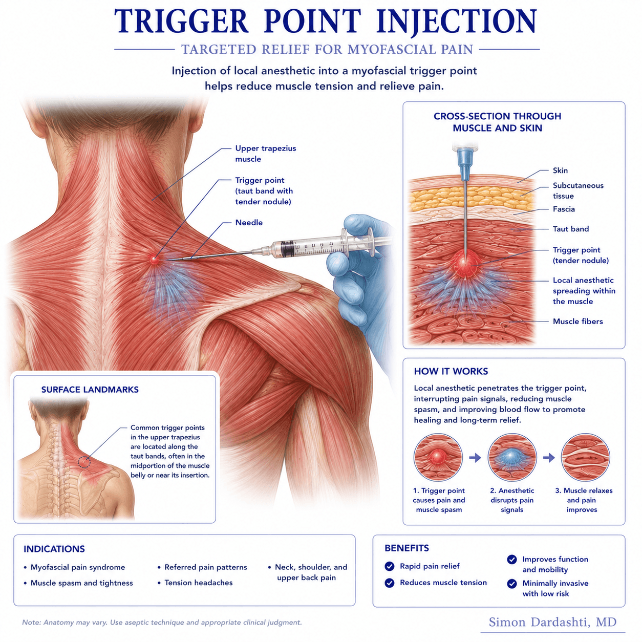 Trigger point injection showing needle placement into myofascial trigger point, local anesthetic and medication delivery to inflamed muscle tissue, and pain reduction mechanism