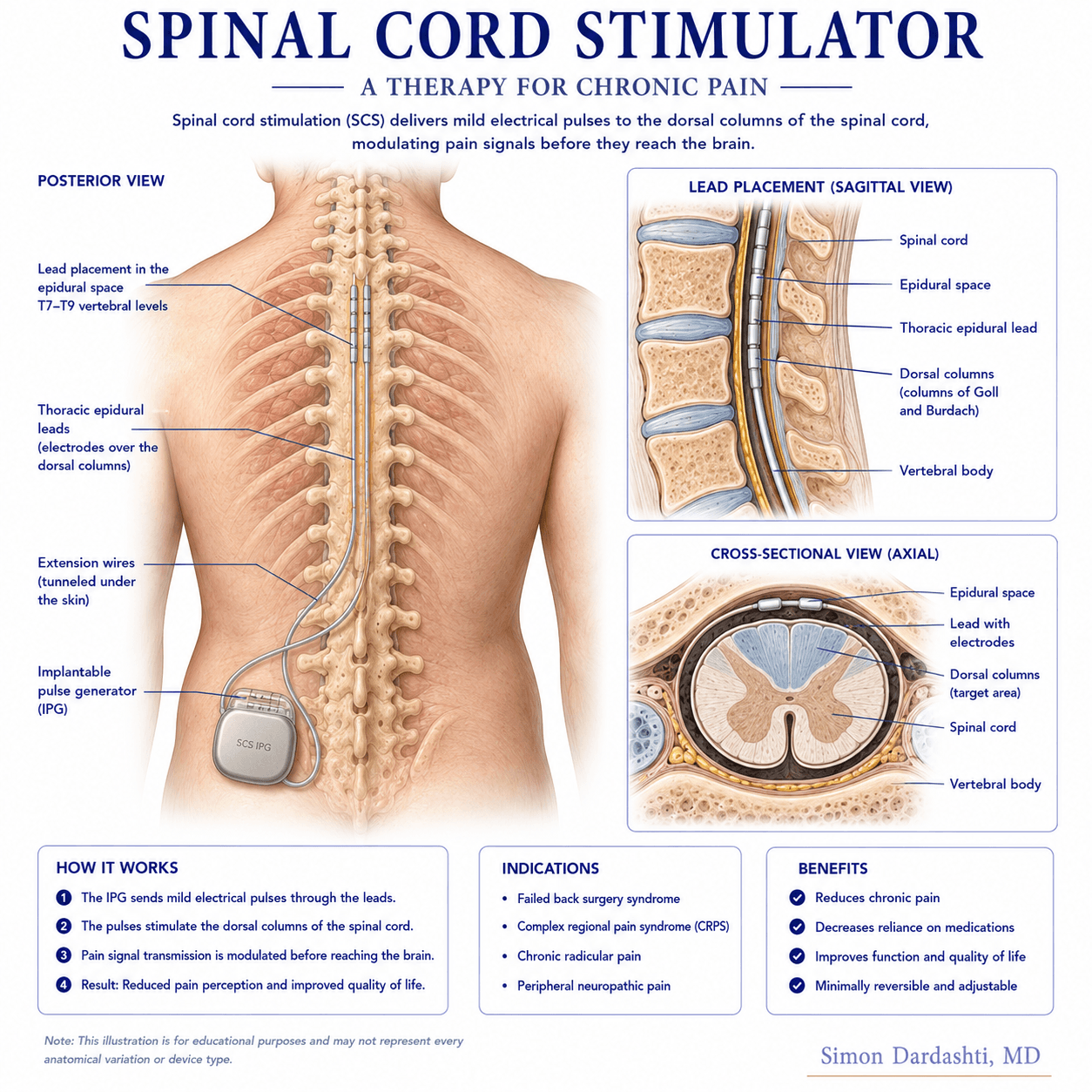 Spinal cord stimulator system showing implanted pulse generator (IPG) in buttock/abdomen area, lead extending to epidural space, battery components, and patient remote control programmer for adjusting stimulation settings